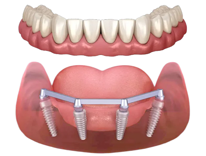 Dentures vs. Dental Implants pros and cons at Basin Dental Group
